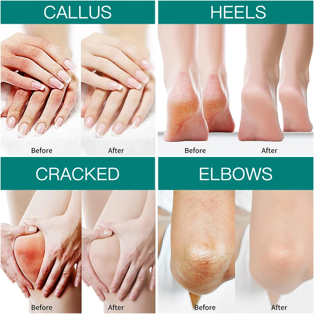 Crème Pieds Talons Fendillés 40% Urée – Exfoliante Réparatrice & Hydratante 70g