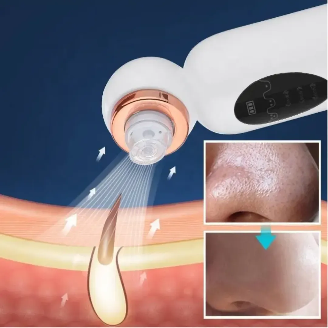 Aspirateur de Points Noirs et d'Acné Rechargeable – Nettoyeur de Pores avec Fonction de Massage et Tête en Silicone
