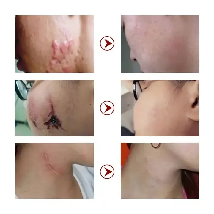 Crème Réparatrice Anti-Cicatrices & Vergetures – LANEMAY | Réduction des Taches, Soins du Visage et de la peau 