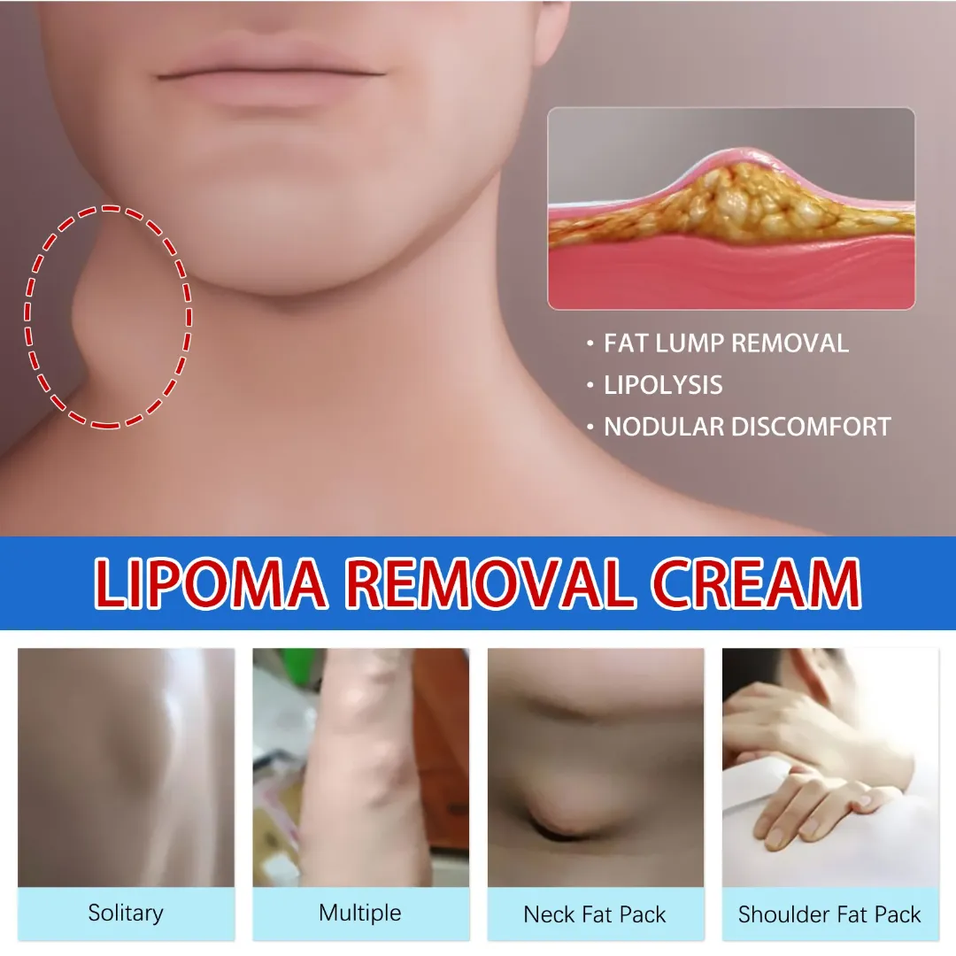Oem Lipome Crème Peau Nodulaire Pommade Plâtre Naturel Aux Herbes