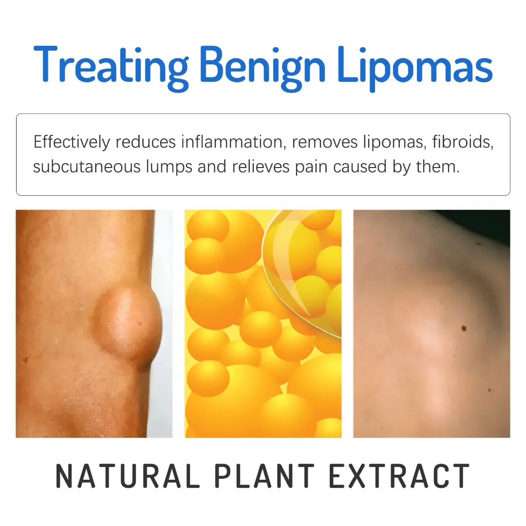 Oem Lipome Crème Peau Nodulaire Pommade Plâtre Naturel Aux Herbes