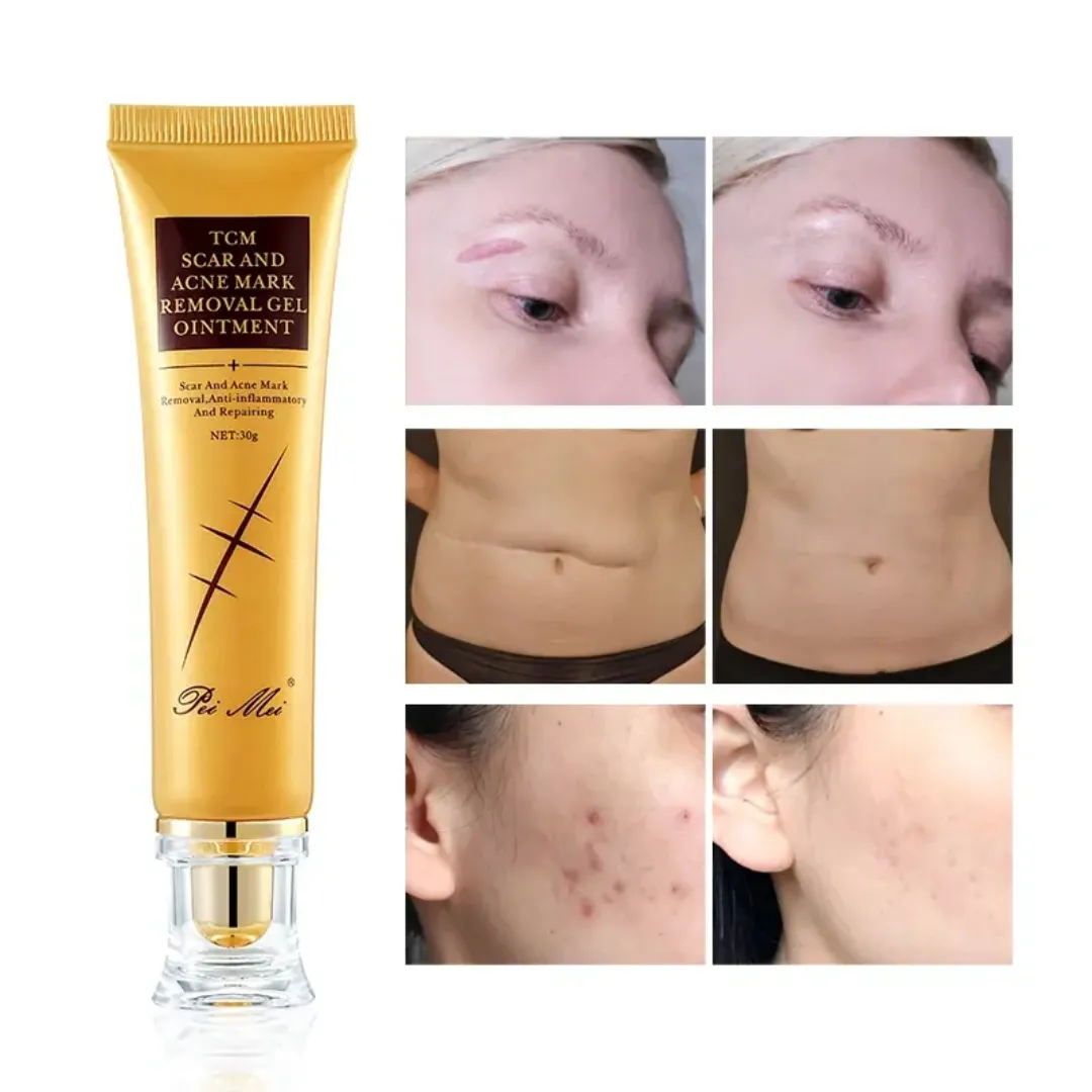 Meilleure crème originale pour cicatrices d'acné, vergetures et cicatrices de grossesse