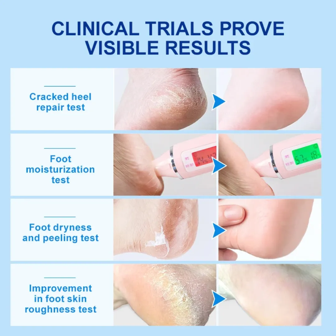 Joypretty Crème Pieds Bio Urea 42% Cracked Heels Exfoliant Anti Crack Peeling Enlèvement de la Peau Morte Soin des Pieds