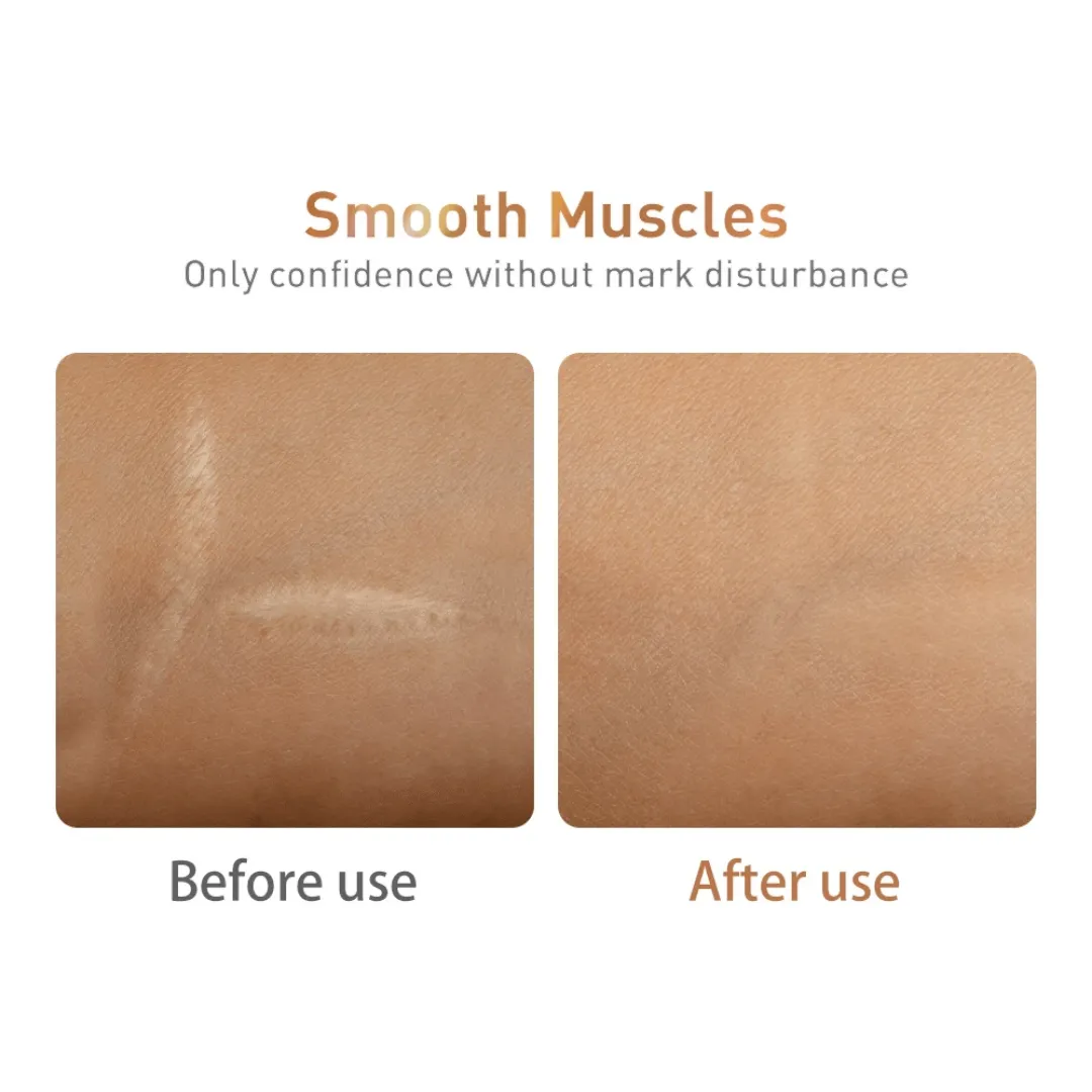 LANBENA Sérum Anti-Acné et Anti-Cicatrices