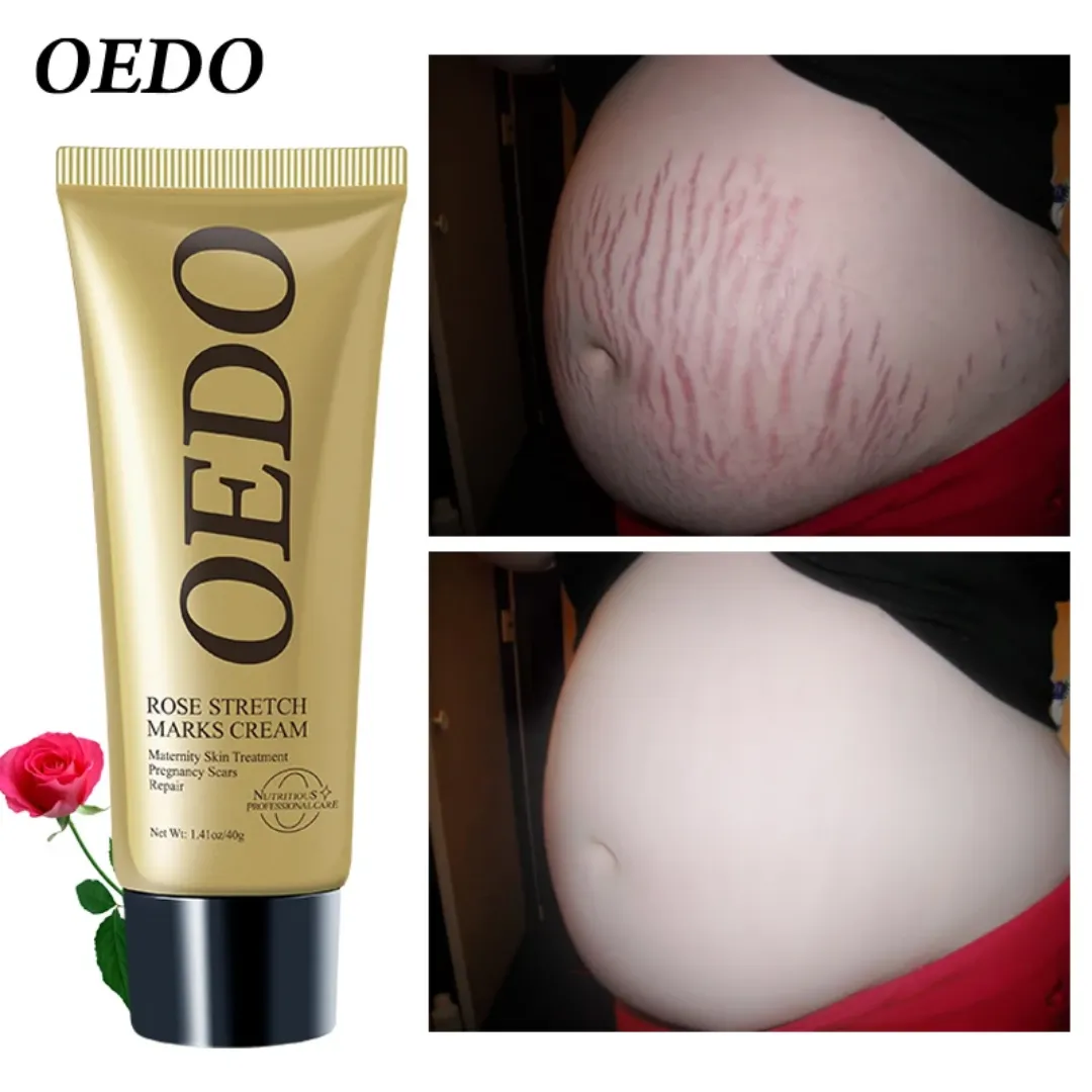 OEDO Crème Vergetures à la rose Réparation des cicatrices Vergetures Soins de la peau de maternité Produits de soins de la peau raffermissants pour femmes 30g